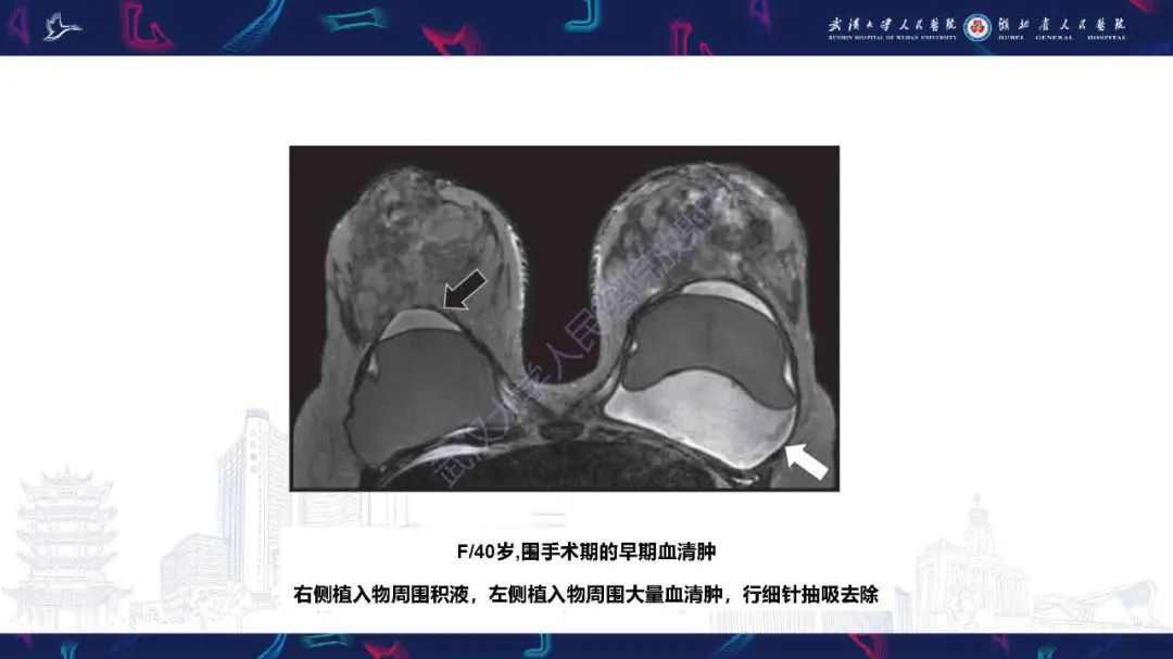 影像PPT - 【PPT】隆胸术后并发症MRI诊断-15