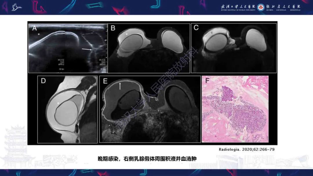 影像PPT - 【PPT】隆胸术后并发症MRI诊断-16