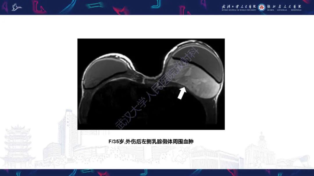 影像PPT - 【PPT】隆胸术后并发症MRI诊断-17