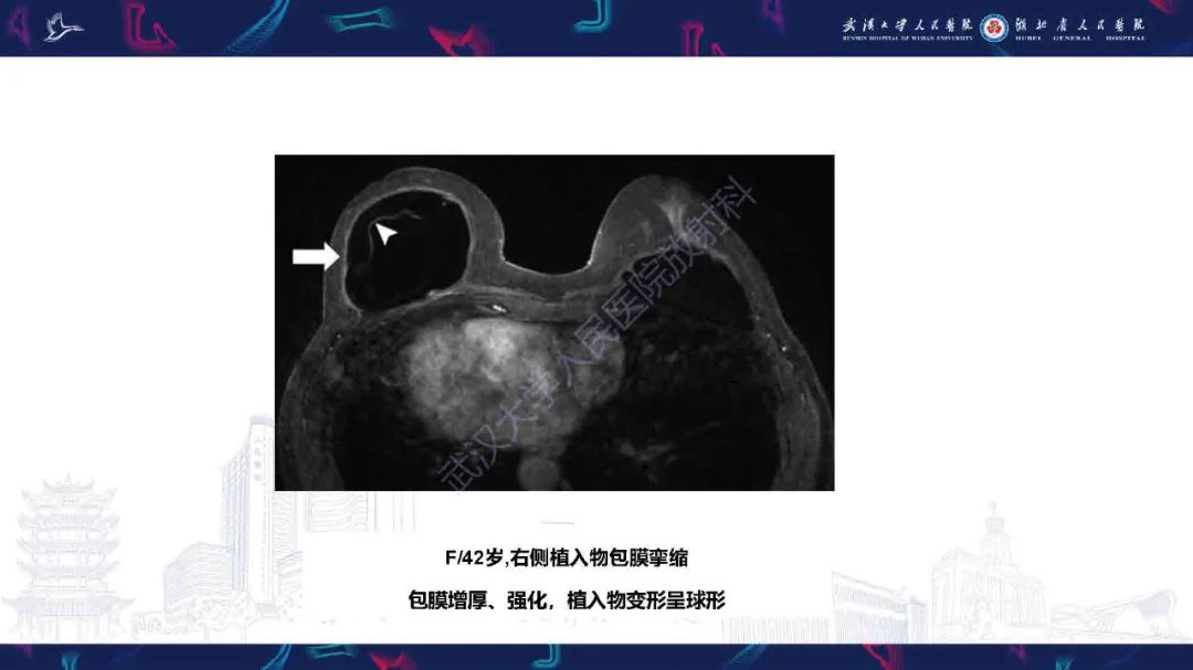 影像PPT - 【PPT】隆胸术后并发症MRI诊断-21