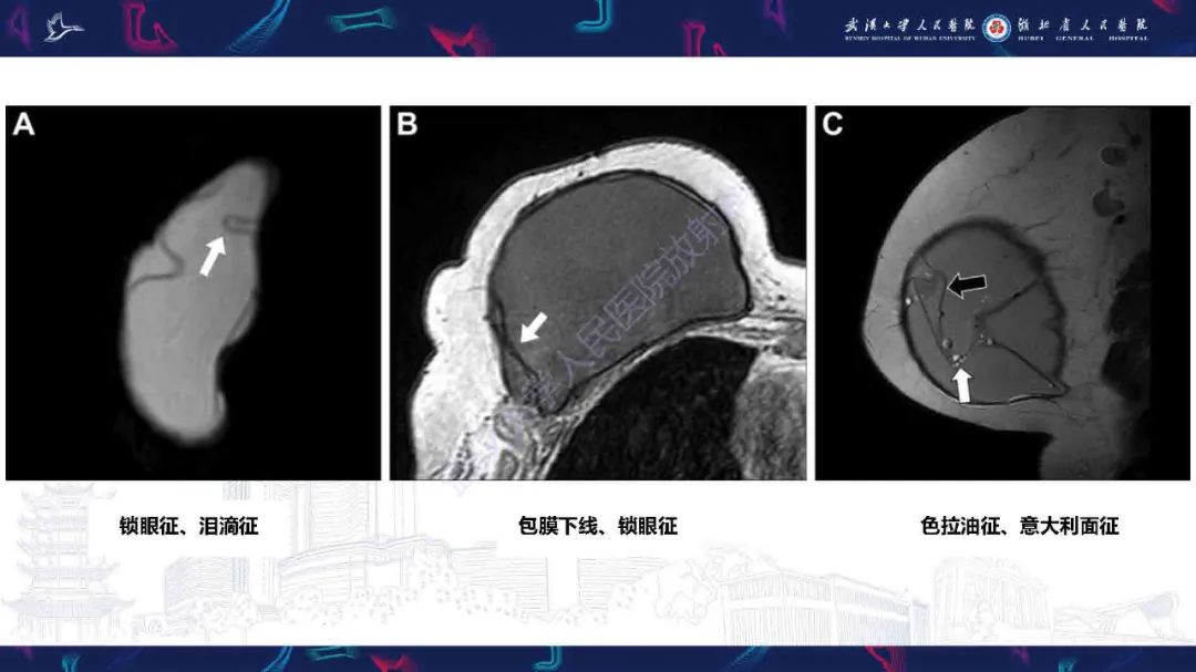 影像PPT - 【PPT】隆胸术后并发症MRI诊断-27