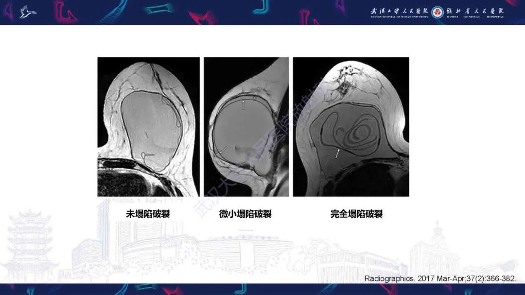 影像PPT - 【PPT】隆胸术后并发症MRI诊断-31