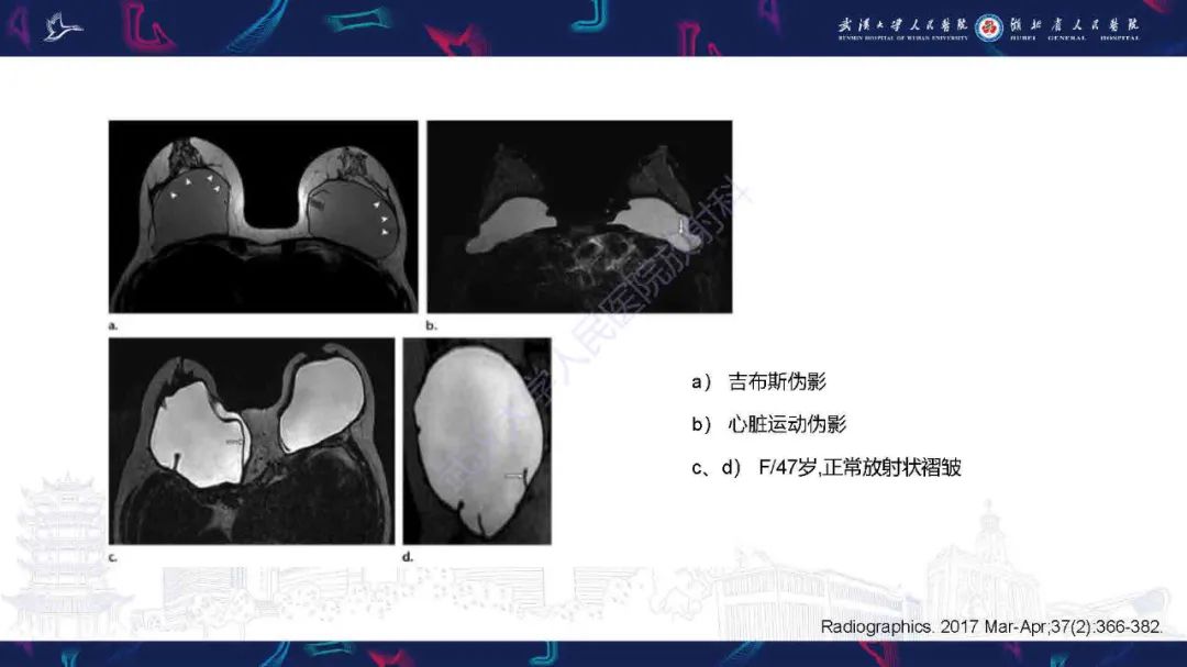 影像PPT - 【PPT】隆胸术后并发症MRI诊断-33