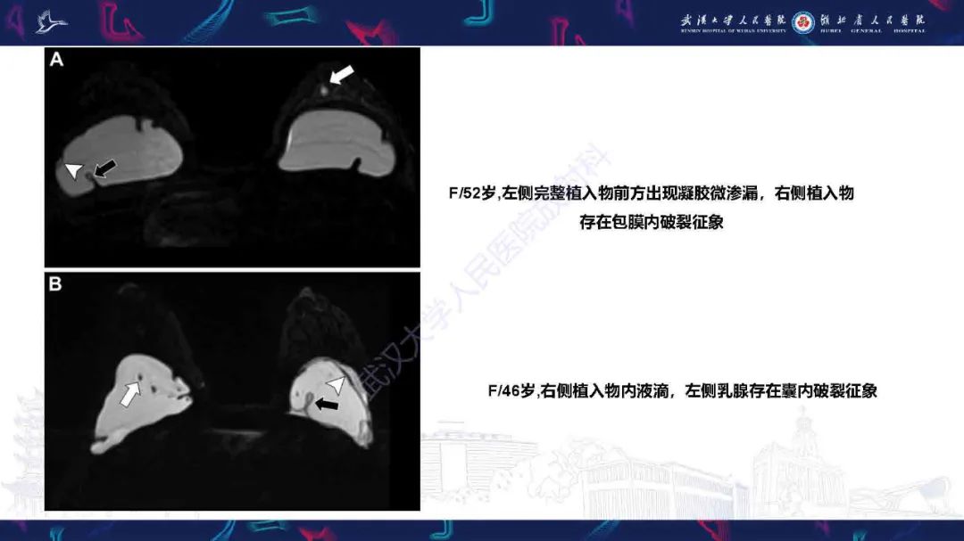 影像PPT - 【PPT】隆胸术后并发症MRI诊断-34