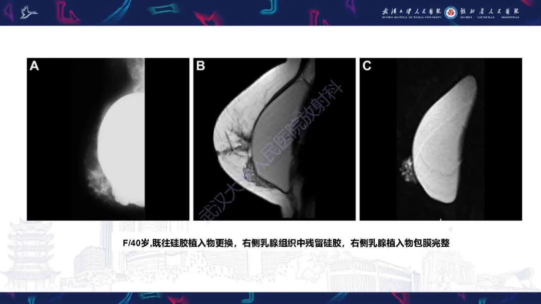 影像PPT - 【PPT】隆胸术后并发症MRI诊断-35