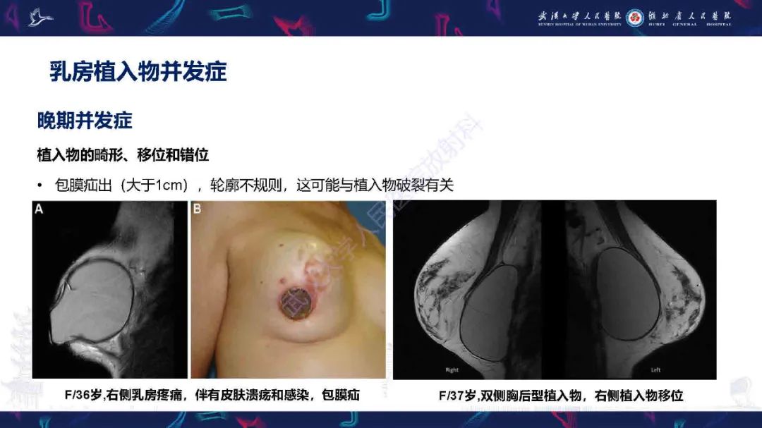 影像PPT - 【PPT】隆胸术后并发症MRI诊断-36