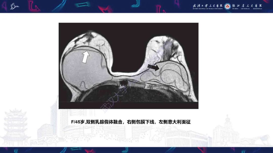 影像PPT - 【PPT】隆胸术后并发症MRI诊断-37