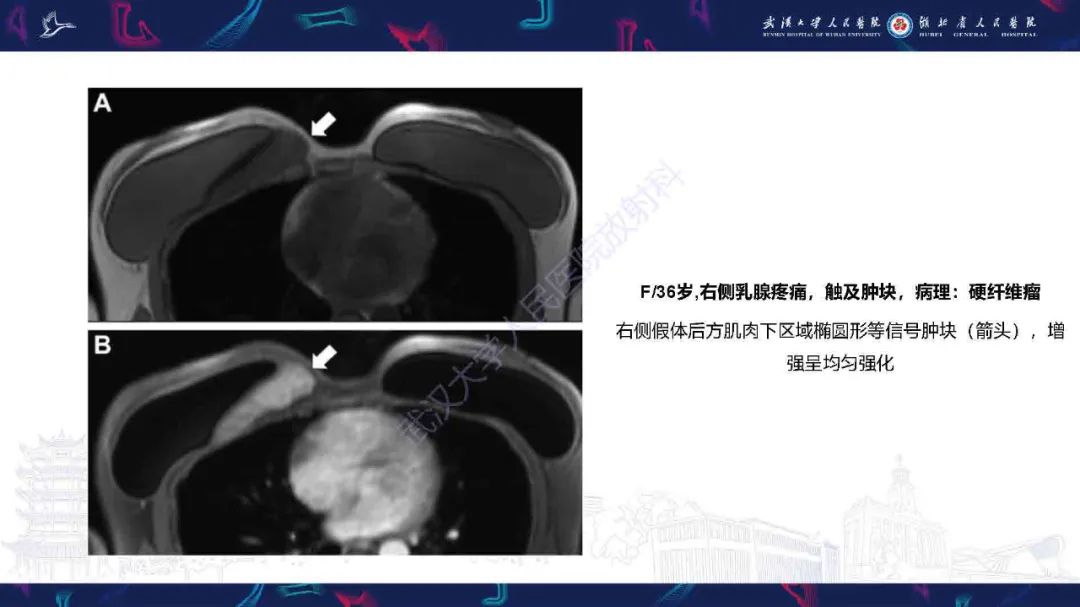 影像PPT - 【PPT】隆胸术后并发症MRI诊断-39