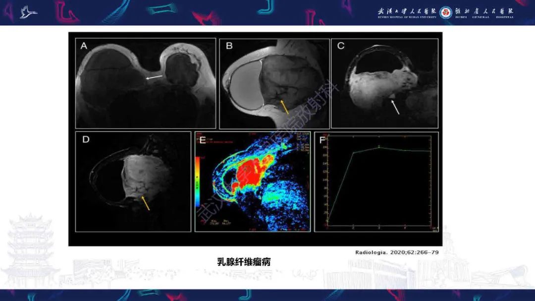 影像PPT - 【PPT】隆胸术后并发症MRI诊断-40