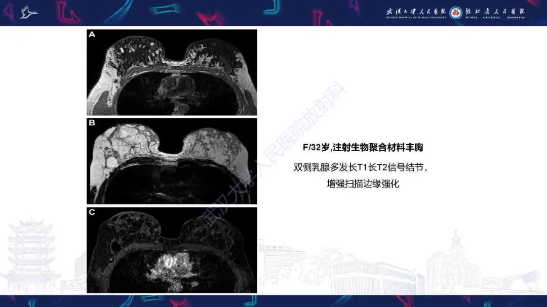 影像PPT - 【PPT】隆胸术后并发症MRI诊断-46