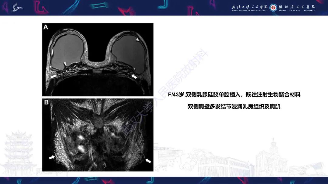 影像PPT - 【PPT】隆胸术后并发症MRI诊断-47