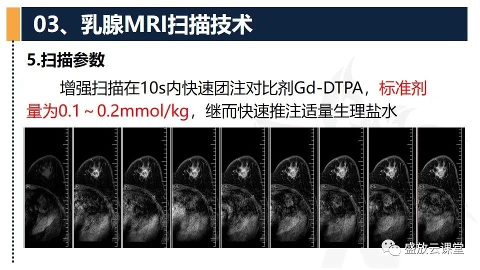 影像PPT - 【PPT】乳腺磁共振检查技术-17