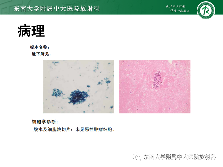 影像PPT - 【PPT】肝窦阻塞综合征-3 影像PPT - 【PPT】肝窦阻塞综合征-3