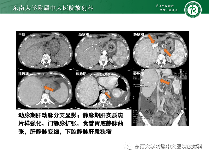 影像PPT - 【PPT】肝窦阻塞综合征-18 影像PPT - 【PPT】肝窦阻塞综合征-18