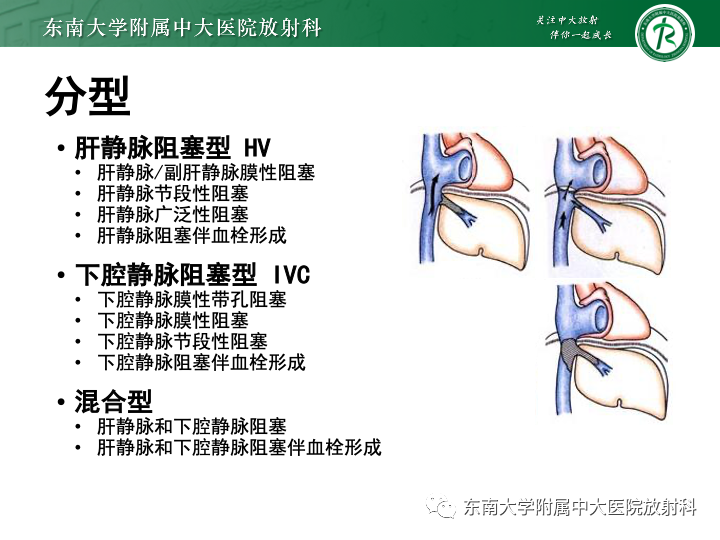 影像PPT - 【PPT】肝窦阻塞综合征-24 影像PPT - 【PPT】肝窦阻塞综合征-24