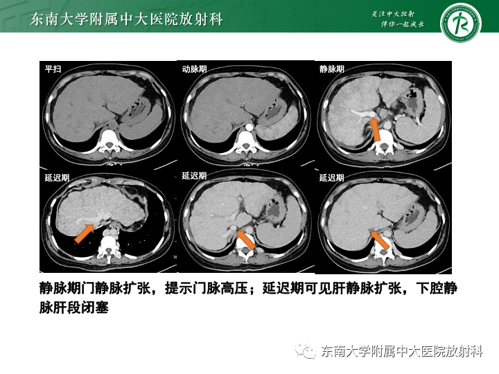 影像PPT - 【PPT】肝窦阻塞综合征-28 影像PPT - 【PPT】肝窦阻塞综合征-28