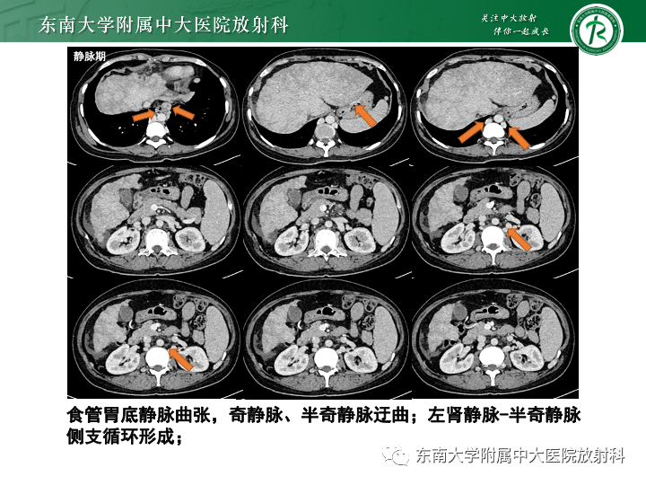 影像PPT - 【PPT】肝窦阻塞综合征-29 影像PPT - 【PPT】肝窦阻塞综合征-29