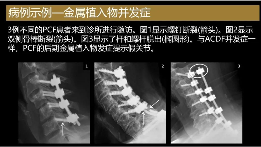 影像PPT - 【PPT】评估围手术期脊柱:除了退行性椎间盘疾病和金属植入物的并发症外-2