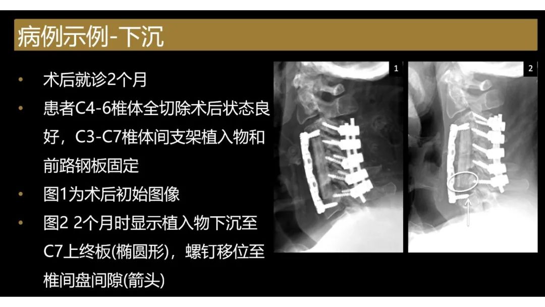 影像PPT - 【PPT】评估围手术期脊柱:除了退行性椎间盘疾病和金属植入物的并发症外-8