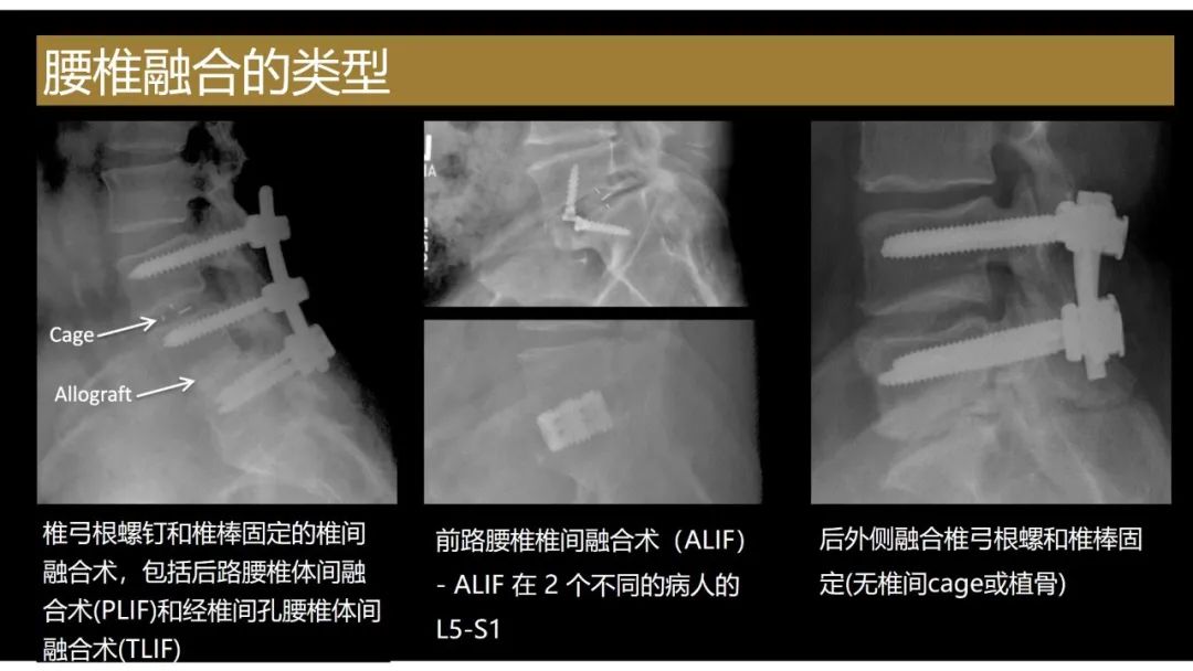 影像PPT - 【PPT】评估围手术期脊柱:除了退行性椎间盘疾病和金属植入物的并发症外-12