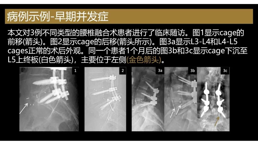影像PPT - 【PPT】评估围手术期脊柱:除了退行性椎间盘疾病和金属植入物的并发症外-20