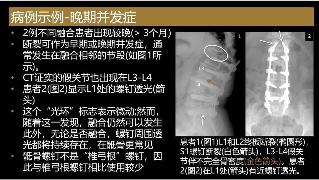 影像PPT - 【PPT】评估围手术期脊柱:除了退行性椎间盘疾病和金属植入物的并发症外-22