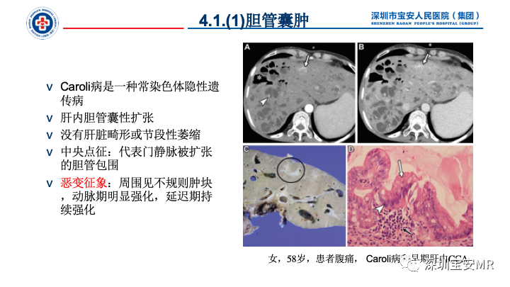 影像PPT - 【PPT】胆道系统癌前病变及病理对照-9