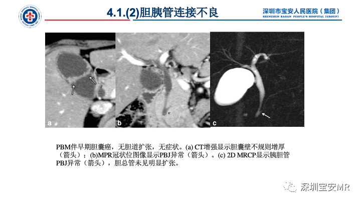 影像PPT - 【PPT】胆道系统癌前病变及病理对照-12