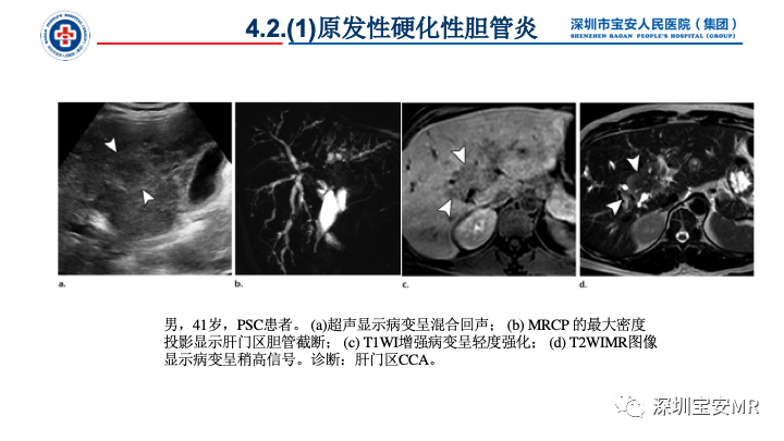 影像PPT - 【PPT】胆道系统癌前病变及病理对照-16