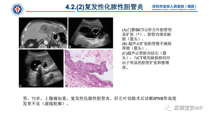 影像PPT - 【PPT】胆道系统癌前病变及病理对照-18