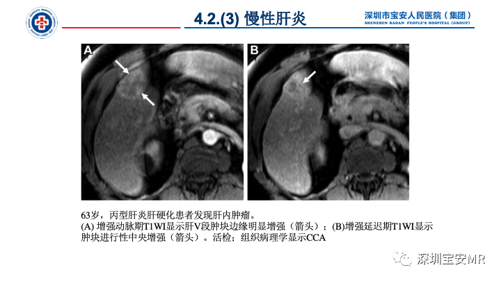 影像PPT - 【PPT】胆道系统癌前病变及病理对照-20
