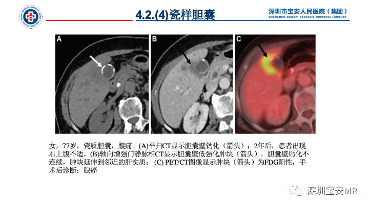 影像PPT - 【PPT】胆道系统癌前病变及病理对照-22