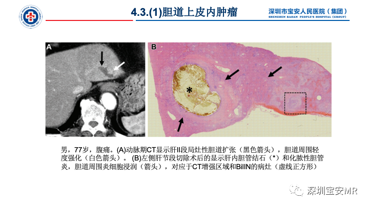影像PPT - 【PPT】胆道系统癌前病变及病理对照-25