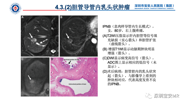 影像PPT - 【PPT】胆道系统癌前病变及病理对照-28