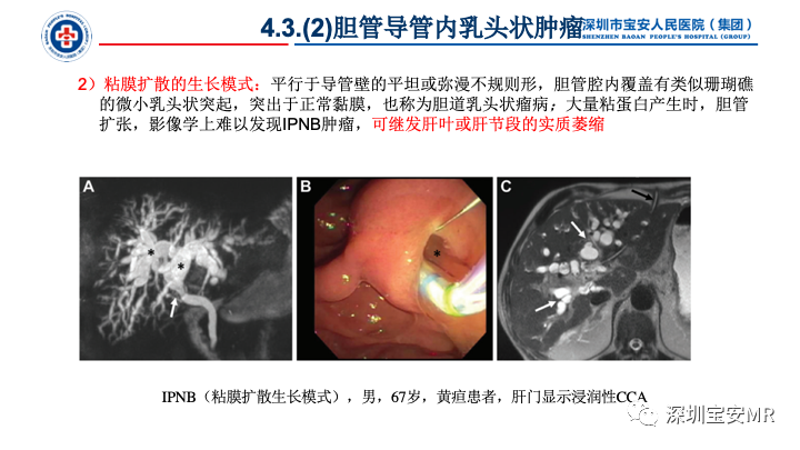 影像PPT - 【PPT】胆道系统癌前病变及病理对照-29