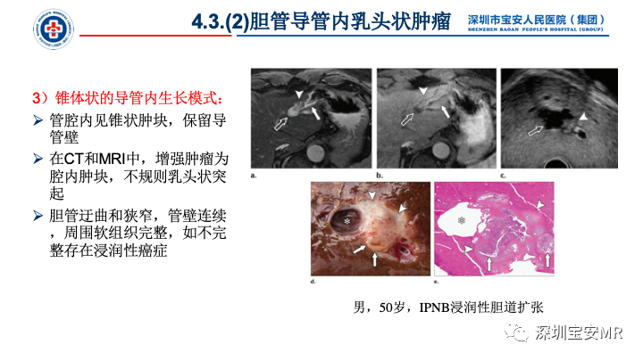 影像PPT - 【PPT】胆道系统癌前病变及病理对照-30