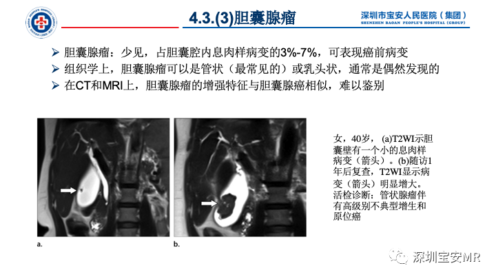 影像PPT - 【PPT】胆道系统癌前病变及病理对照-32