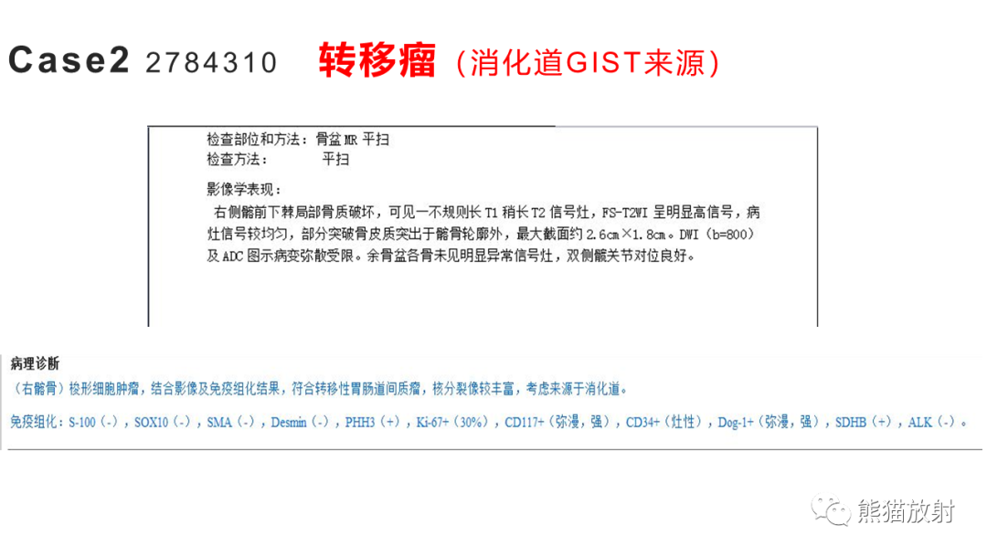影像PPT - 【病例】胸骨浆细胞瘤 VS 髂骨转移瘤-13