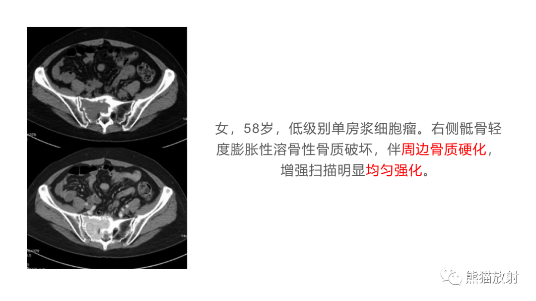 影像PPT - 【病例】胸骨浆细胞瘤 VS 髂骨转移瘤-18