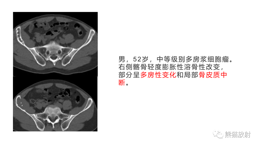 影像PPT - 【病例】胸骨浆细胞瘤 VS 髂骨转移瘤-19