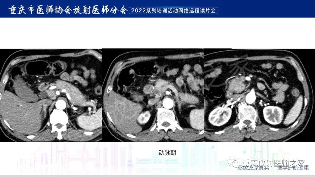 影像PPT - 【病例】肿块型胰腺炎1例CT及MR影像-5