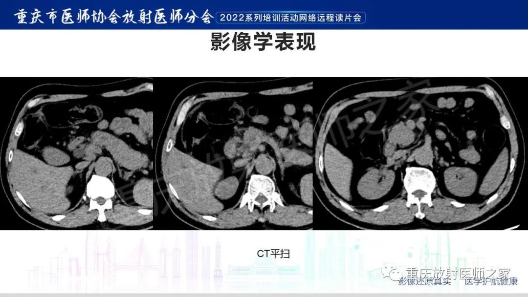 影像PPT - 【病例】肿块型胰腺炎1例CT及MR影像-4