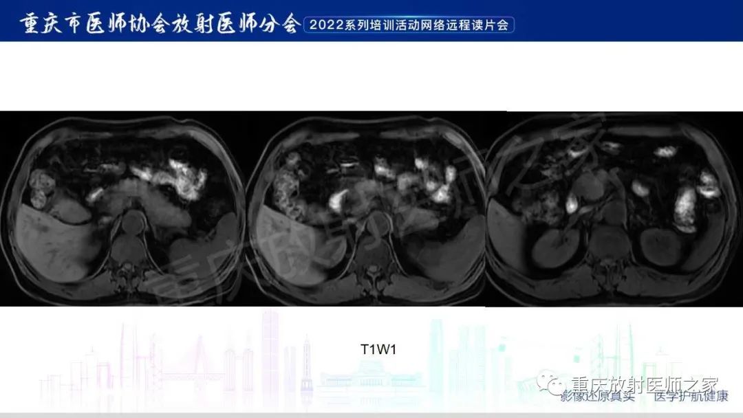 影像PPT - 【病例】肿块型胰腺炎1例CT及MR影像-7