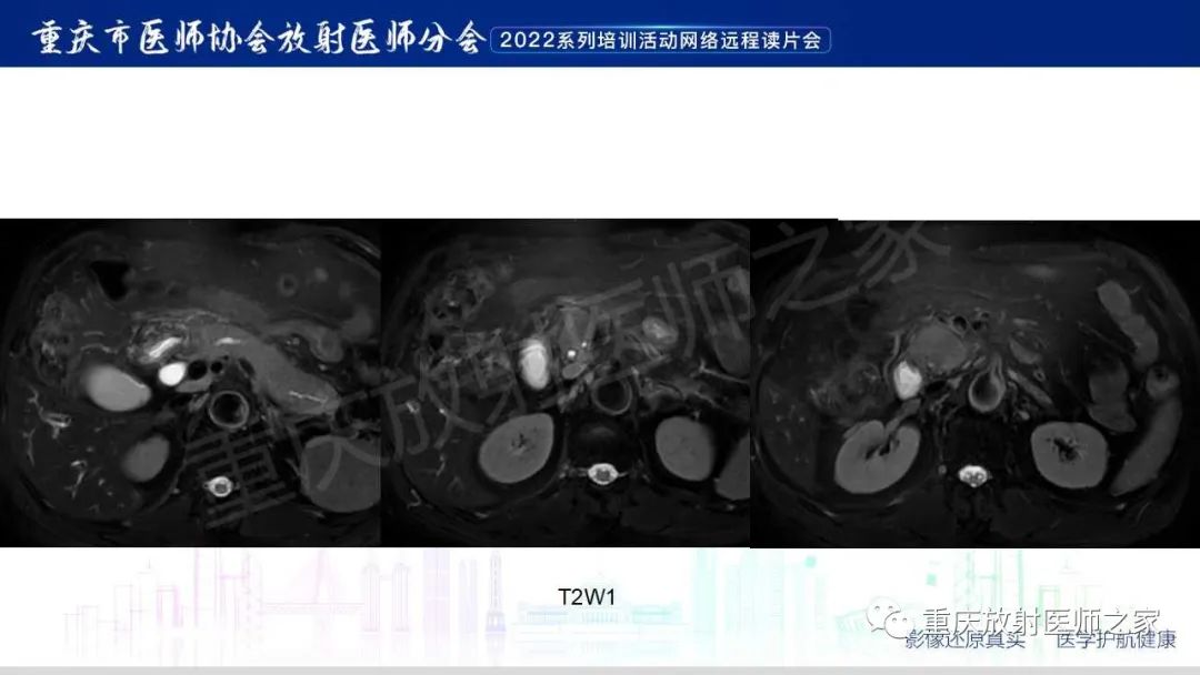 影像PPT - 【病例】肿块型胰腺炎1例CT及MR影像-8