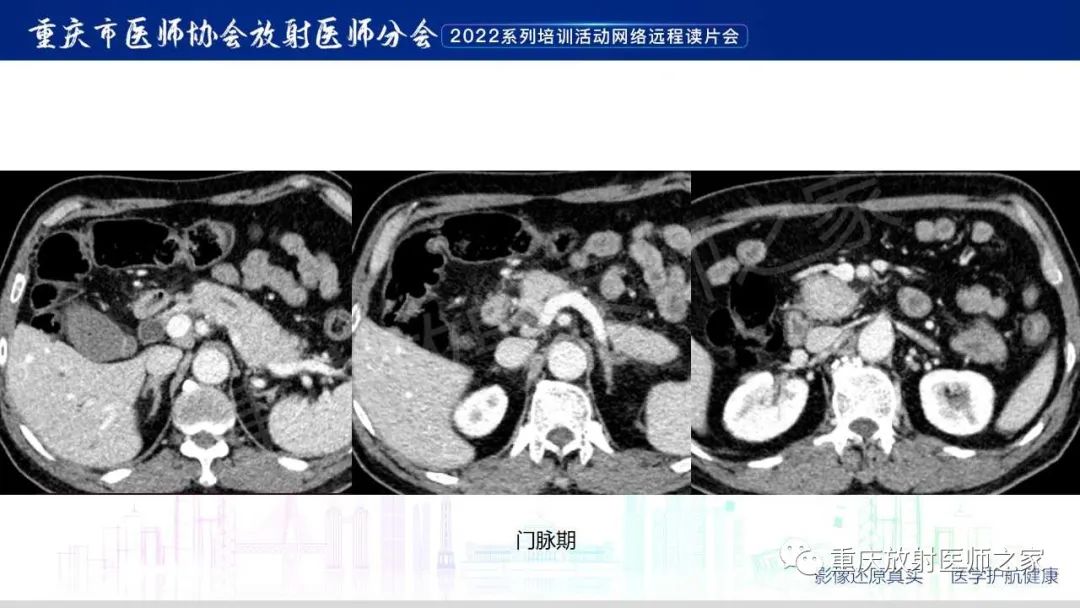 影像PPT - 【病例】肿块型胰腺炎1例CT及MR影像-6