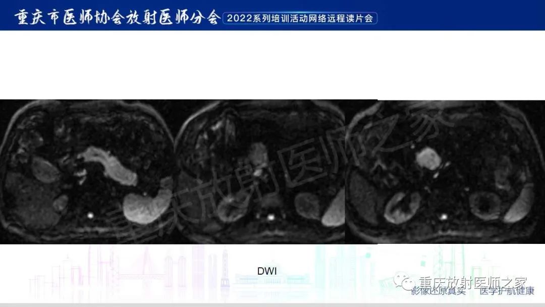 影像PPT - 【病例】肿块型胰腺炎1例CT及MR影像-9