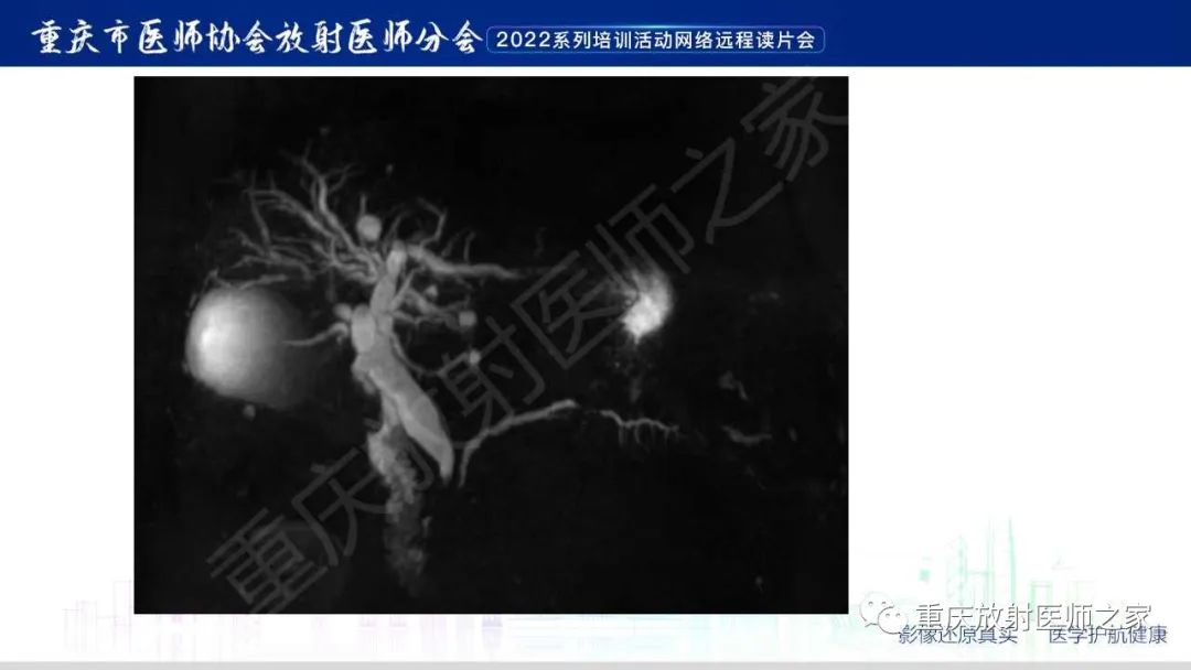 影像PPT - 【病例】肿块型胰腺炎1例CT及MR影像-10