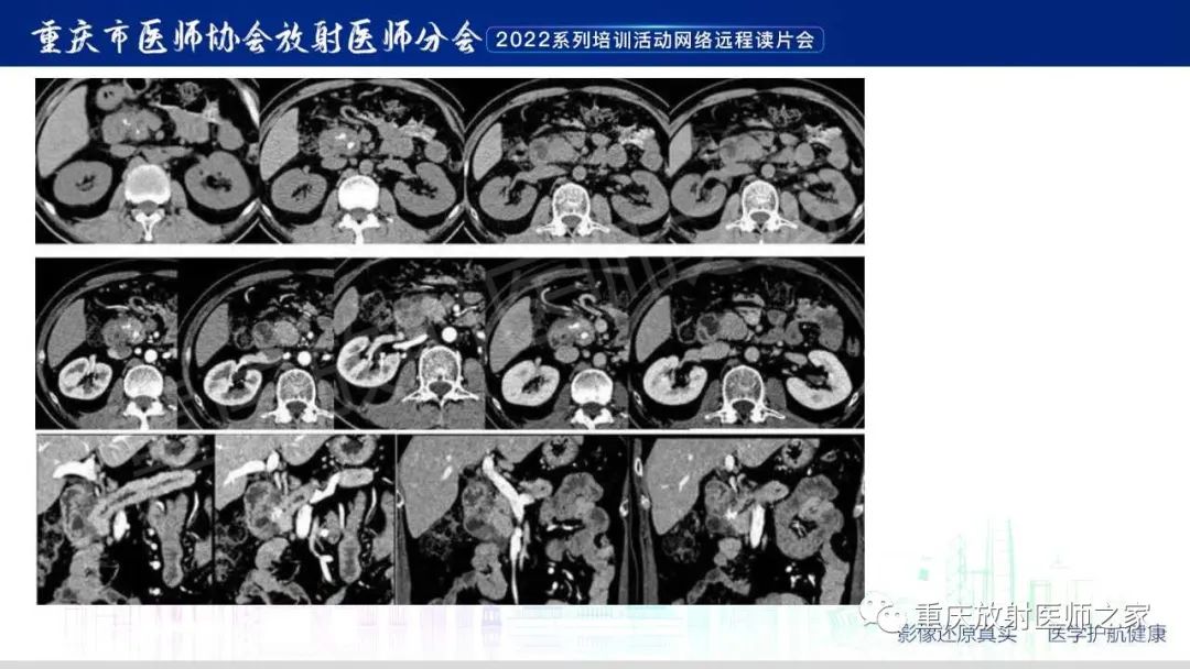 影像PPT - 【病例】肿块型胰腺炎1例CT及MR影像-16