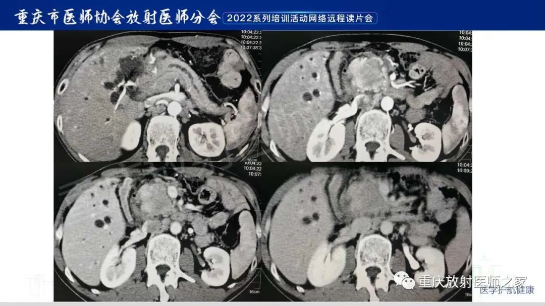 影像PPT - 【病例】肿块型胰腺炎1例CT及MR影像-18
