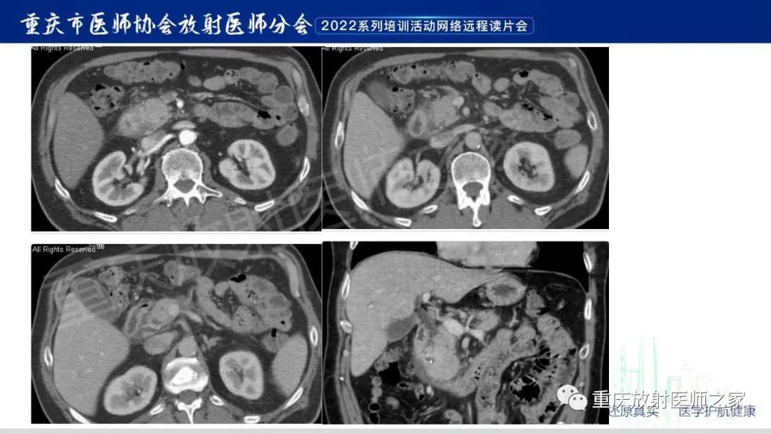 影像PPT - 【病例】肿块型胰腺炎1例CT及MR影像-20